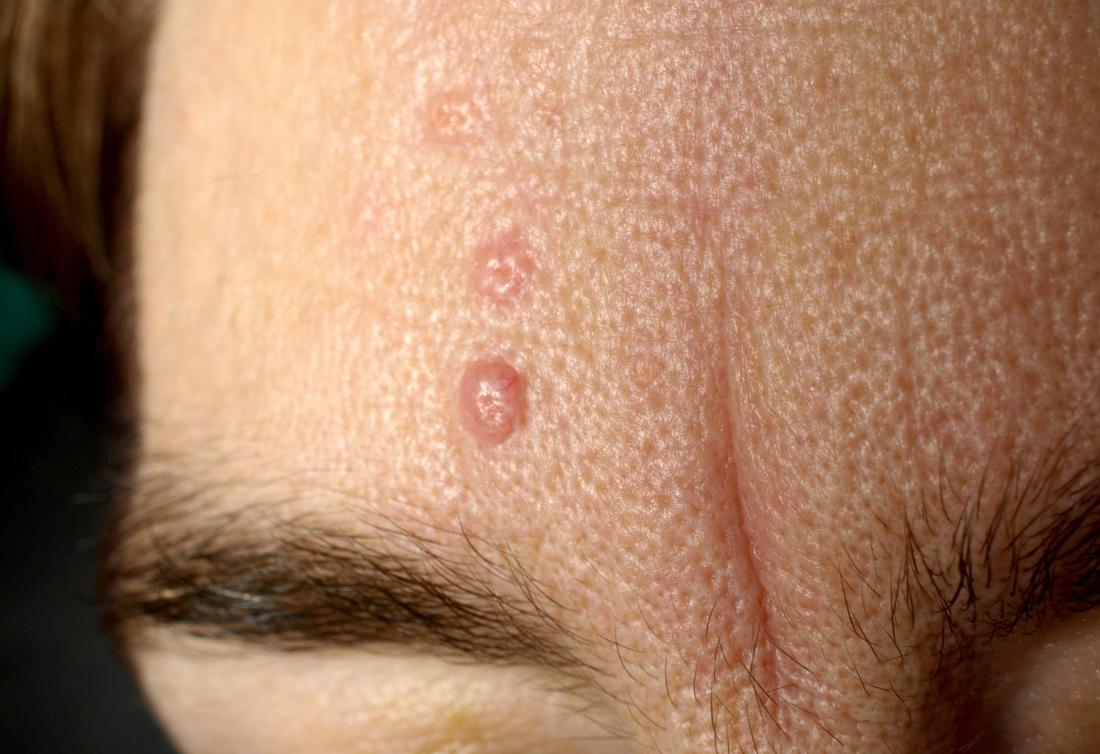 Dermatite seborroica. Credito immagine: Klaus D.Peter, Gummersbach, Germania, (2009, marzo 10)