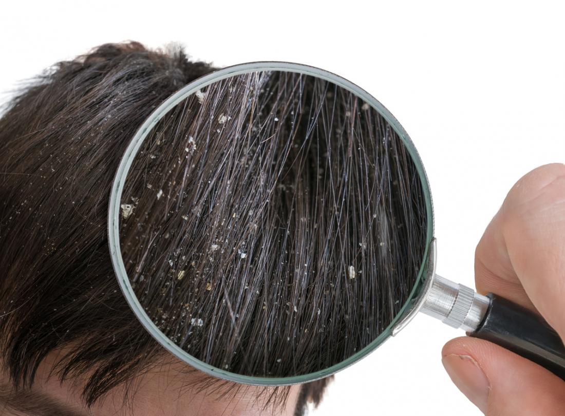 La forfora comporta scaglie di pelle che si accumulano nei capelli.