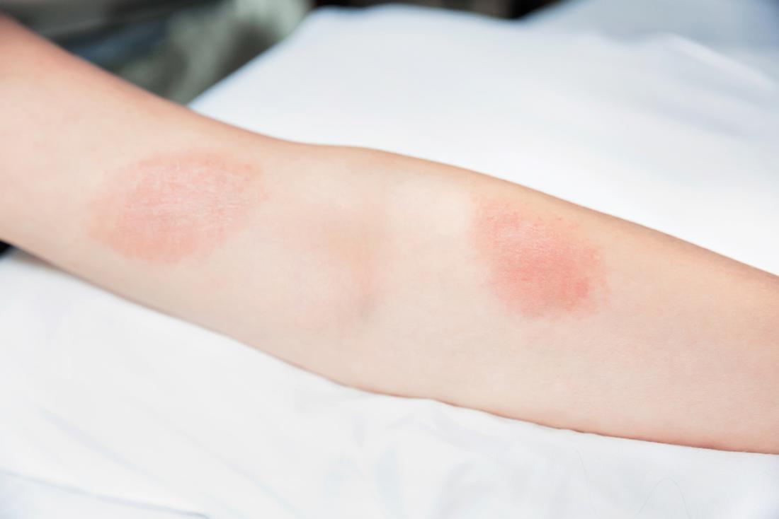 Eruzione di edera velenosa sul braccio di una persona.