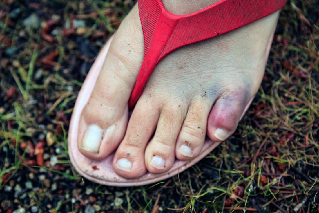 Жена в сандали с наранен и счупен пръст.