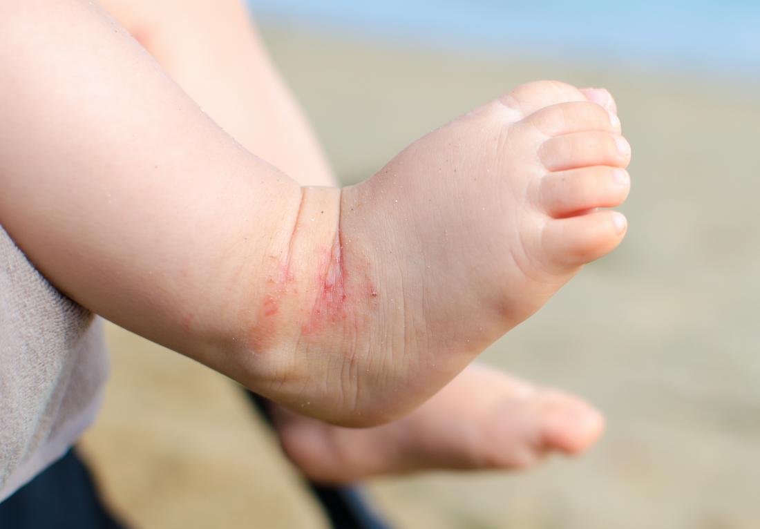 Eczema ao pé de uma criança