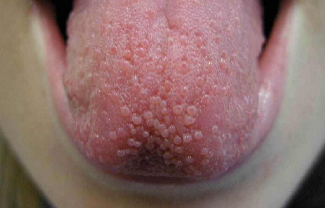 Beulen oder vorübergehende linguale Papillitis auf der Zunge.