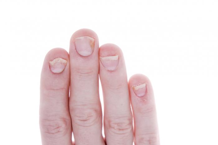 Псориазис на ноктите