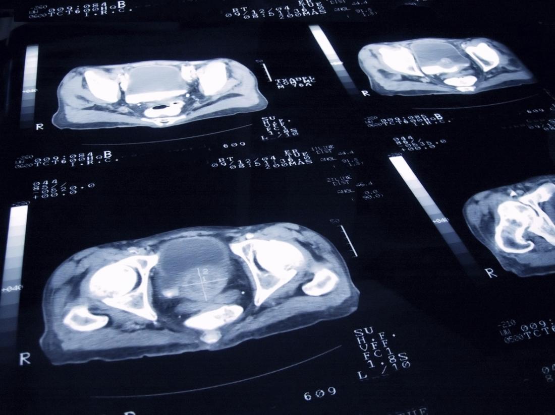 Импулсните сканирания могат да показват и проследяват наличието на рак на простатата.