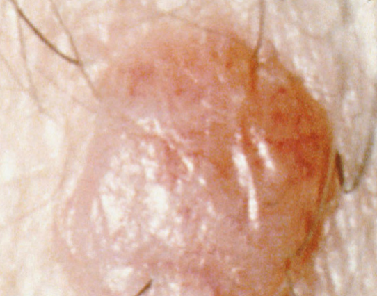 Дермален невус се повдига и може да има коса. Кредит на изображението: Неизвестен фотограф, Национален институт по ракови заболявания, 1985 г.