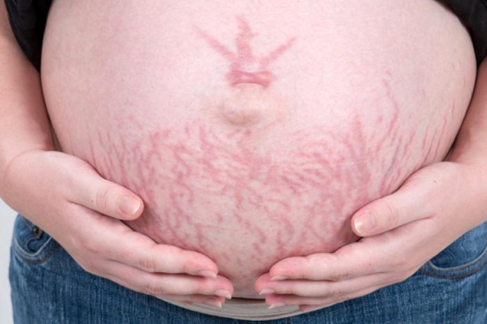 Bụng mang thai có vết rạn da.