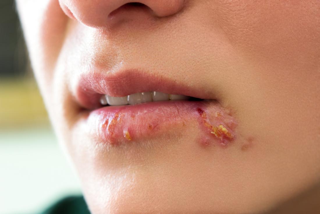 Herpes ist eine Infektion, die durch das Herpes-simplex-Virus verursacht wird - mit Symptomen einschließlich Fieberbläschen im Mund.