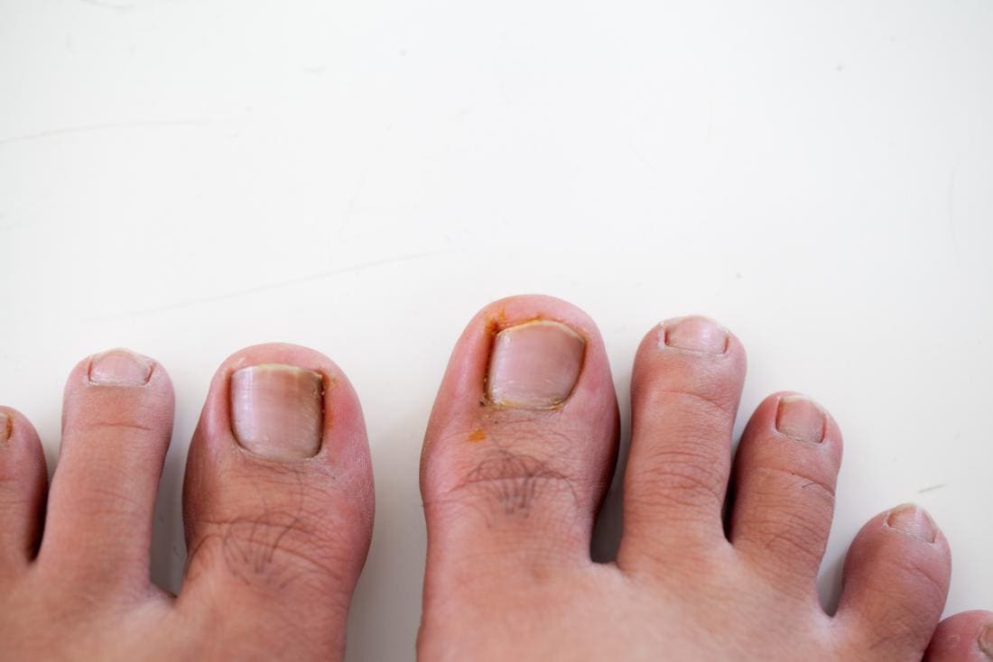 Ongles incarnés sur les pieds.