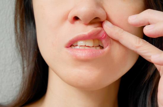 Donna che spinge il labbro superiore per rivelare ulcera e ulcera alla bocca.
