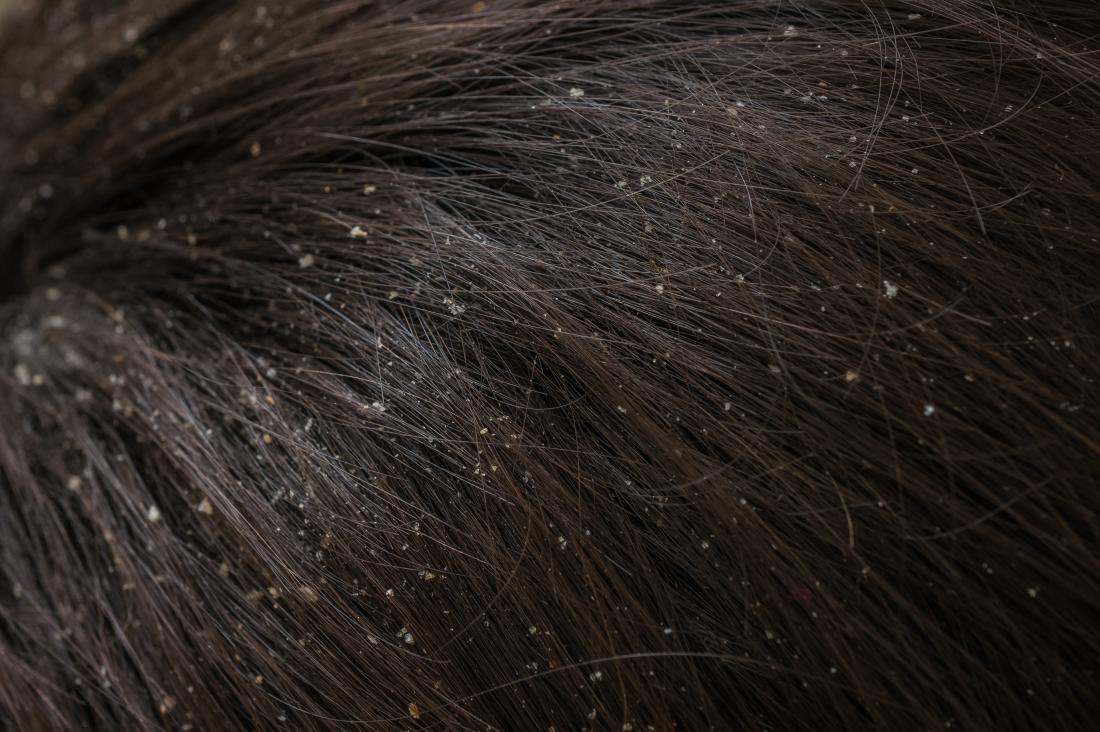 Image de la peau squameuse dans les cheveux du cuir chevelu sec