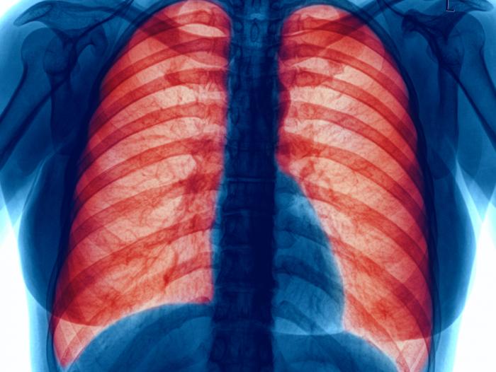 radiografia della malattia polmonare