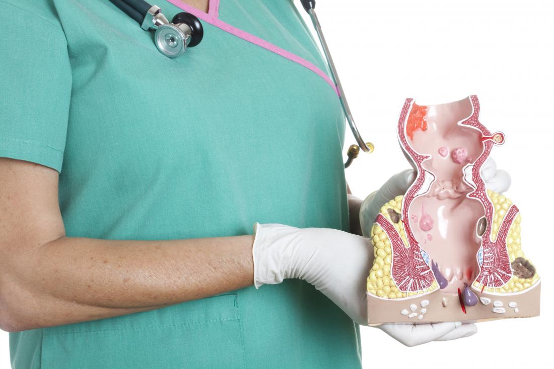 Krankenschwester, die anatomisches Modell des Enddarms und des Anus hält, um thrombosierte Hämorrhoiden zu demonstrieren