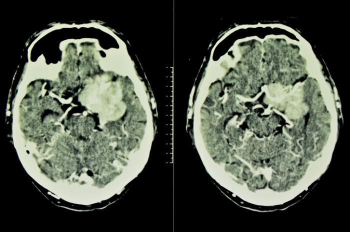 Une tomodensitométrie d'une tumeur cérébrale