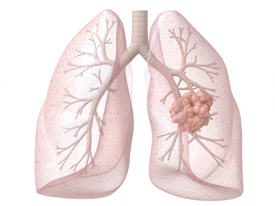 Илюстрация на рак на белия дроб