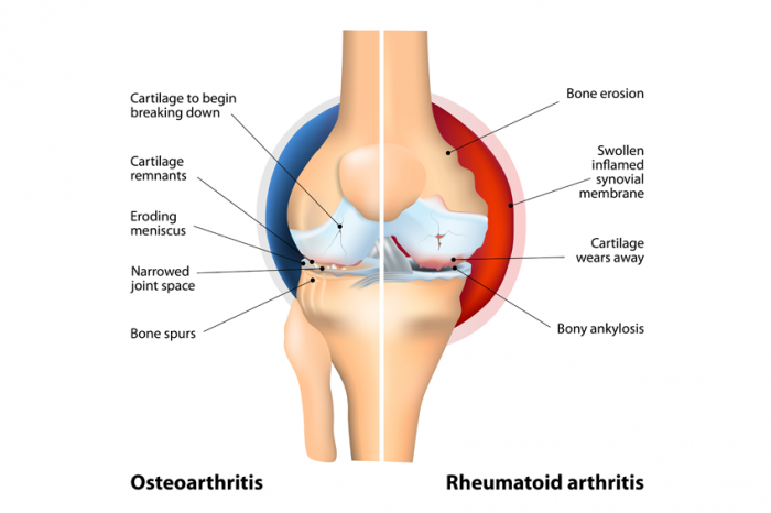 Vergleich von Osteoarthritis und rheumatoider Arthritis