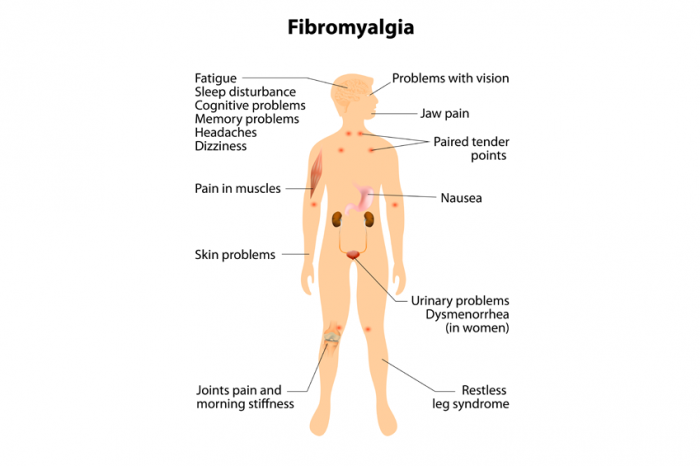 Symptome von Fibromyalgie