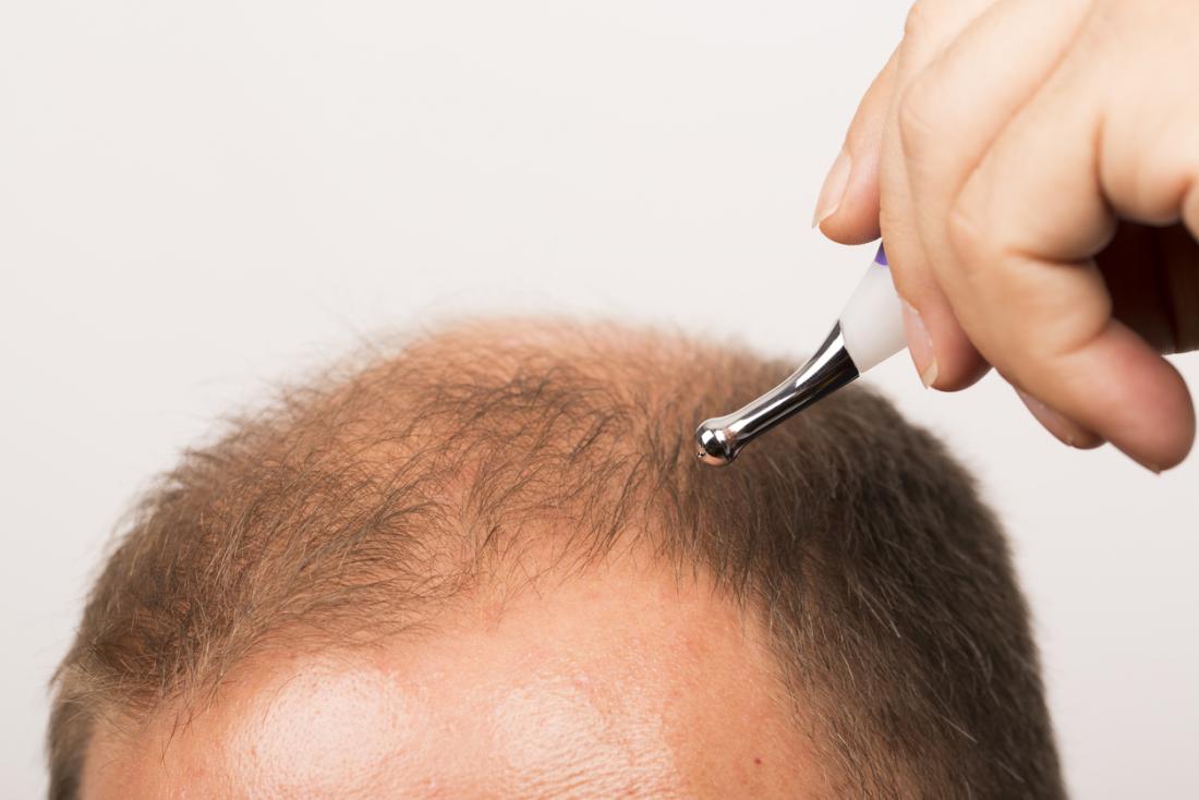 Човек използва формула за растежа на косата при изтъняване, отдръпване на косата.