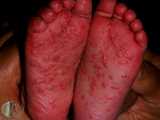 Psoriasis pustuleux sur les pieds de l'enfant.