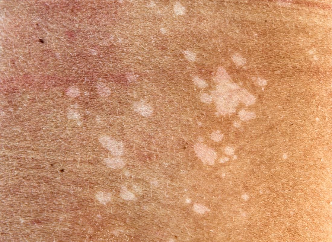 red-spots-on-skin-pictures-causes-treatment-online-dermatology-images