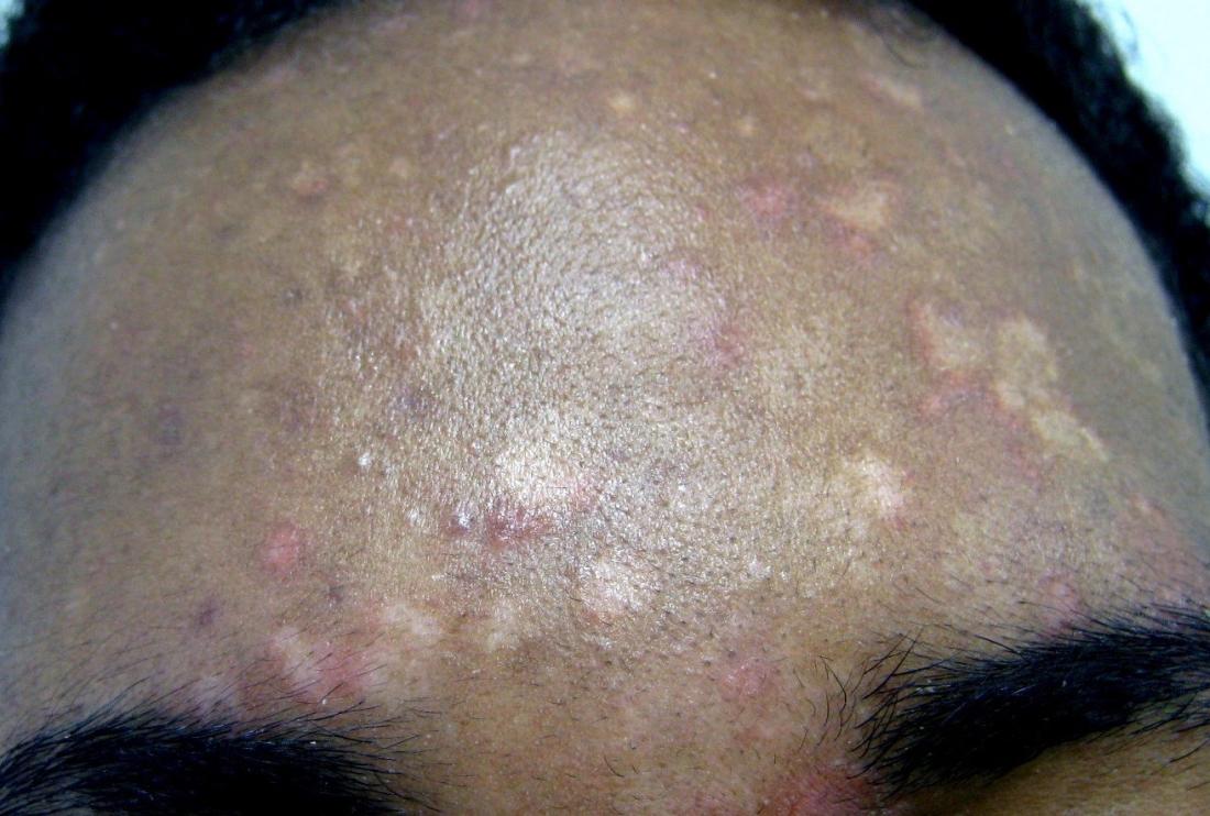Tinea versicolor, ou pityriasis versicolor, provoque des taches blanches sur la peau. Crédit d'image: Grook Da Oger, (22 juillet 2011)