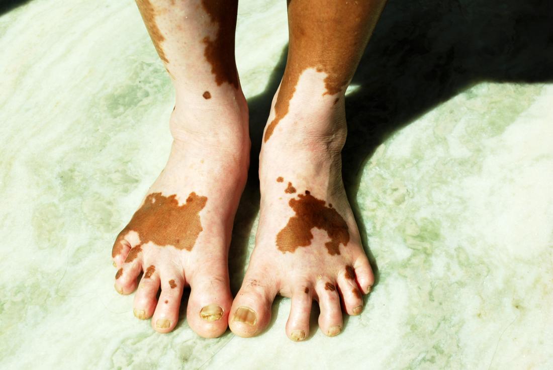 Vitiligo auf Füßen.