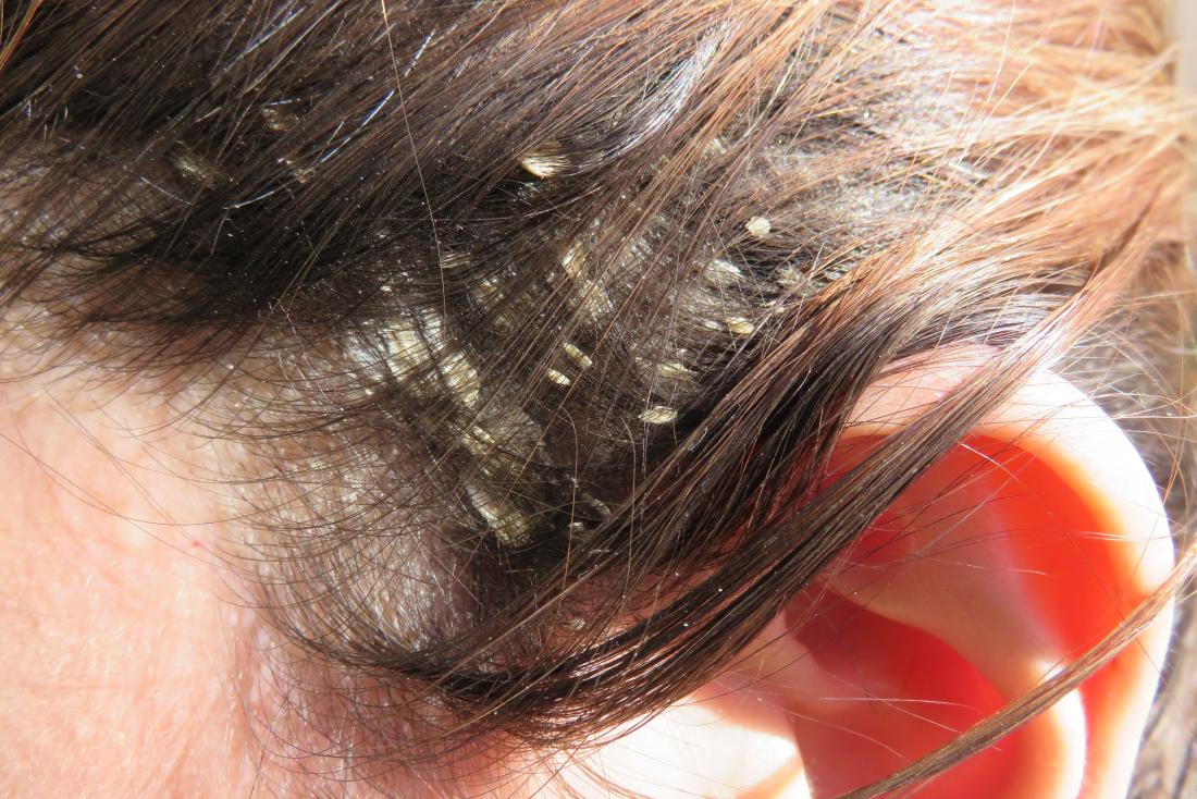 Eczema trên da đầu