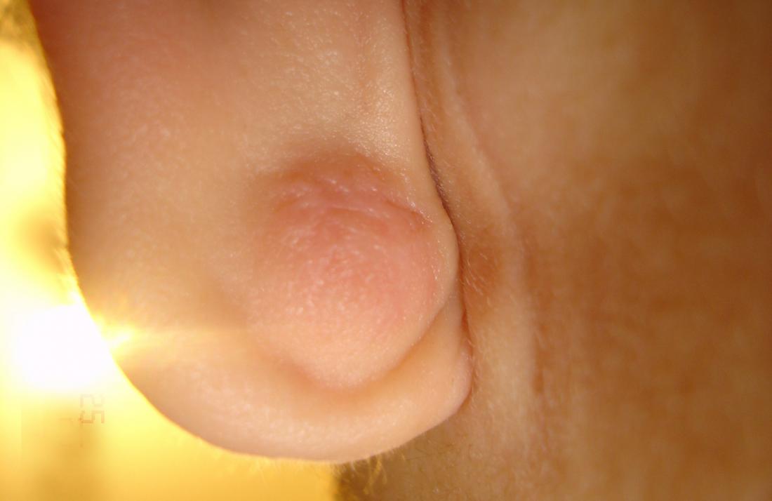 kystes épidermoïdes sur le lobe de l'oreille. Crédit d'image: Jonathan RR, (2007, 25 mai).