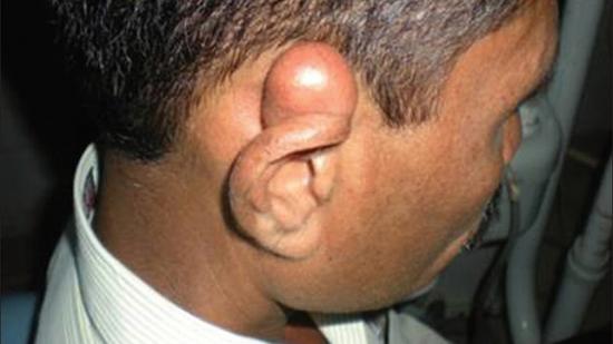 epidermale Einschlusszysten hinter dem Ohr