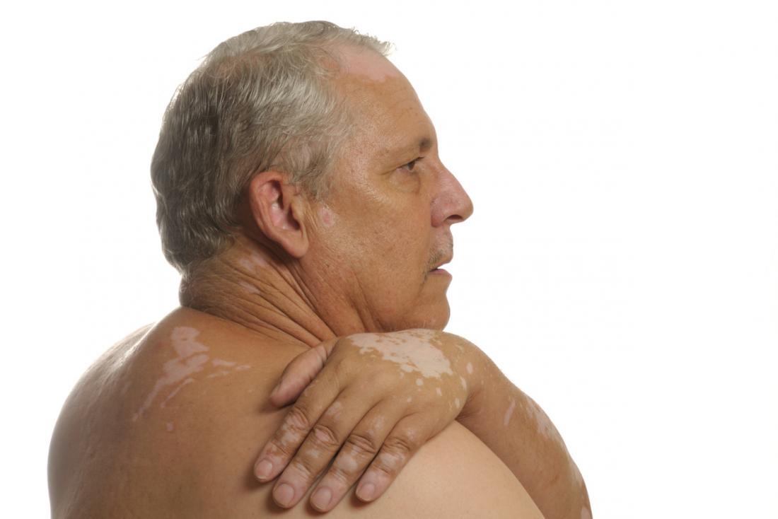 Vitiligo auf der Haut eines kaukasischen Mannes.