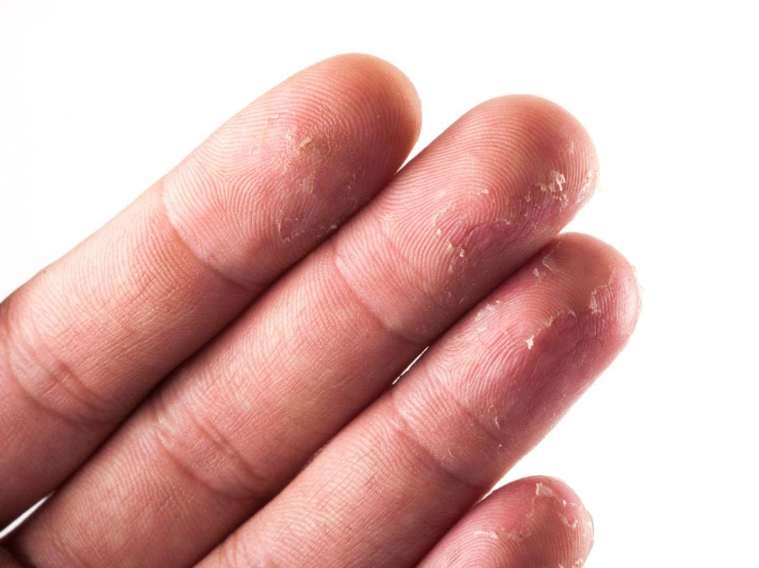 Eczema nas mãos pode causar descamação da pele nas pontas dos dedos