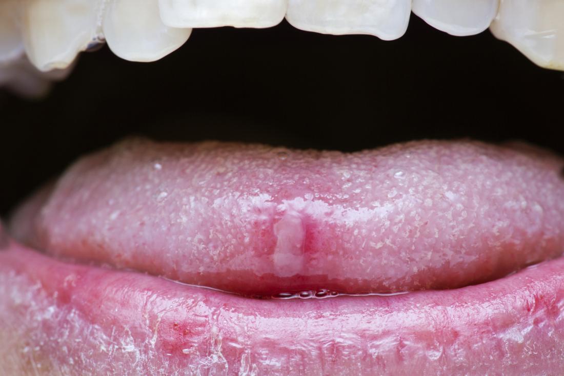 Krebs wund auf der Spitze einer Personen Zunge