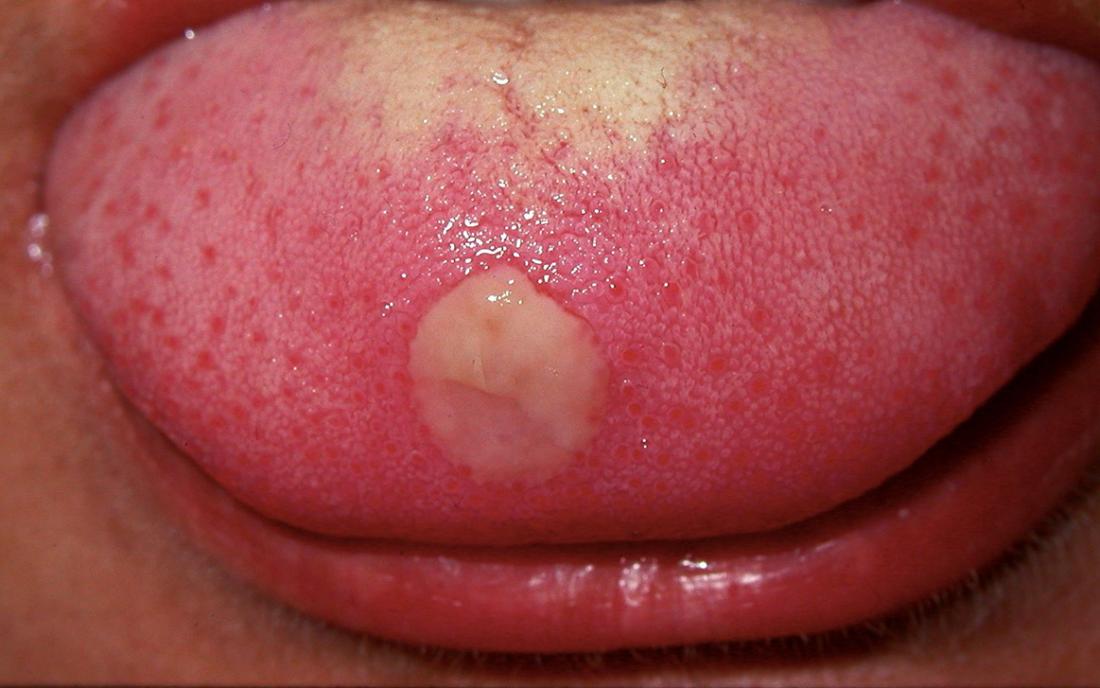 Syphilis auf der Zunge