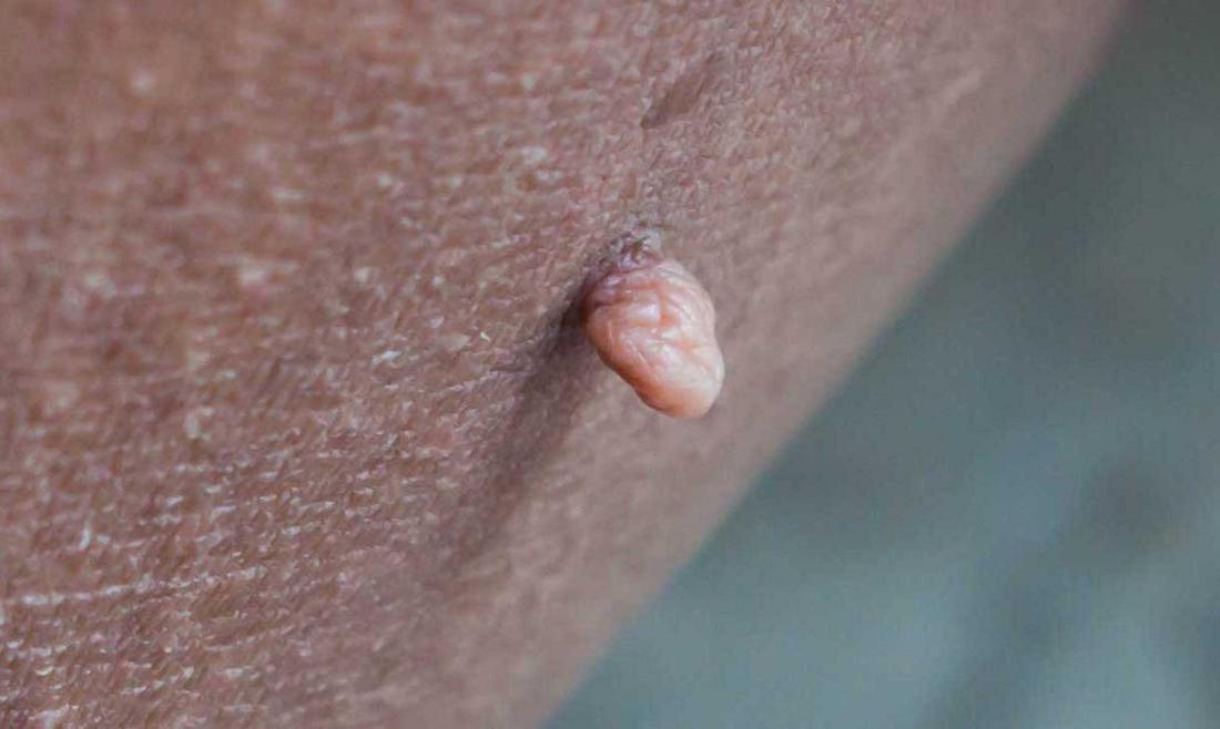 vaginale Hautmarkierung