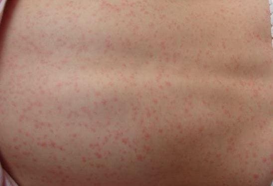 Rash maculopapulare scarlattina. Credito immagine: Estraya, (2007, 9 febbraio).