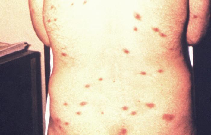 Hautausschlag hiv Wie sieht