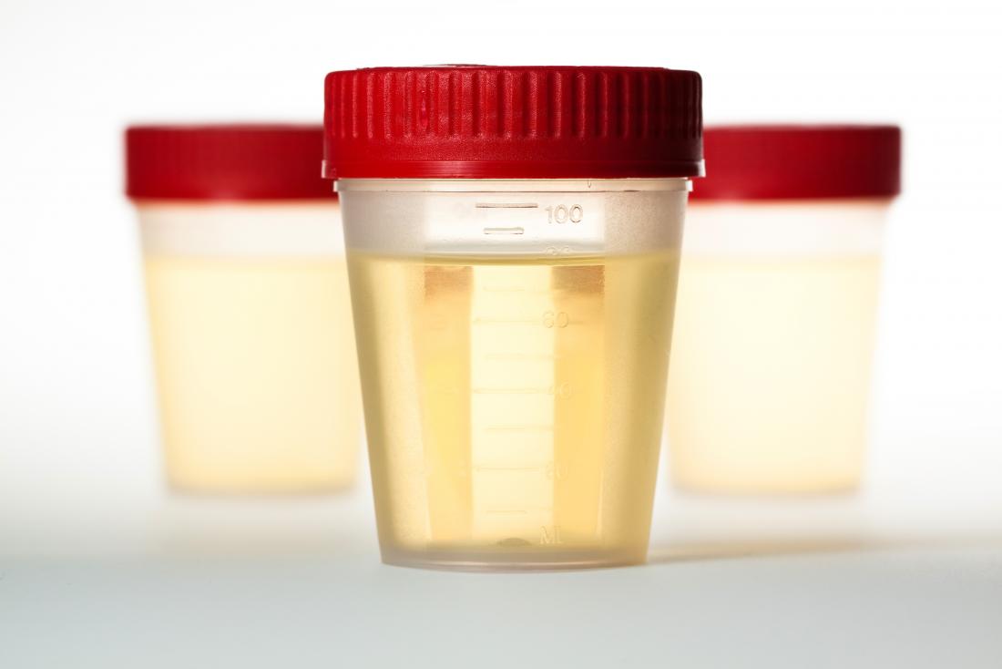 Les nitrates dans l'échantillon d'urine dans un pot en plastique.