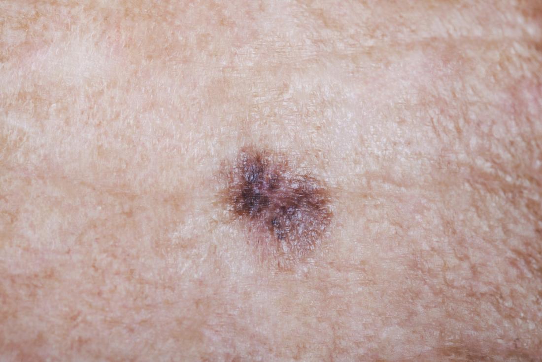 Меланомен маркер за рак на кожата.
