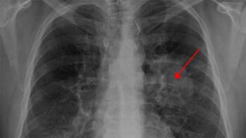Röntgenbild von Lungenkrebs-Tumor