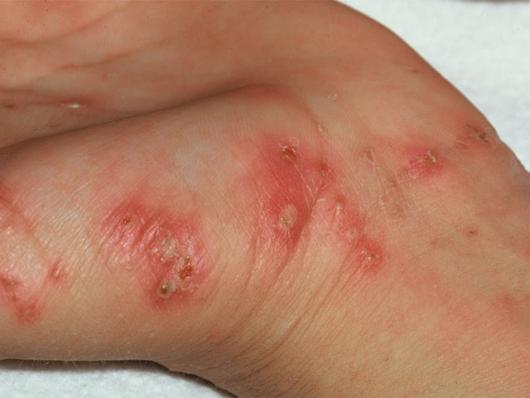 Krätze Hautausschlag an Hand