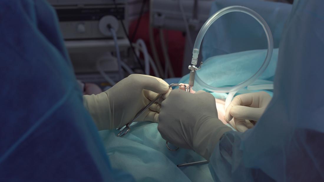 opération utilisant un équipement laparoscopique