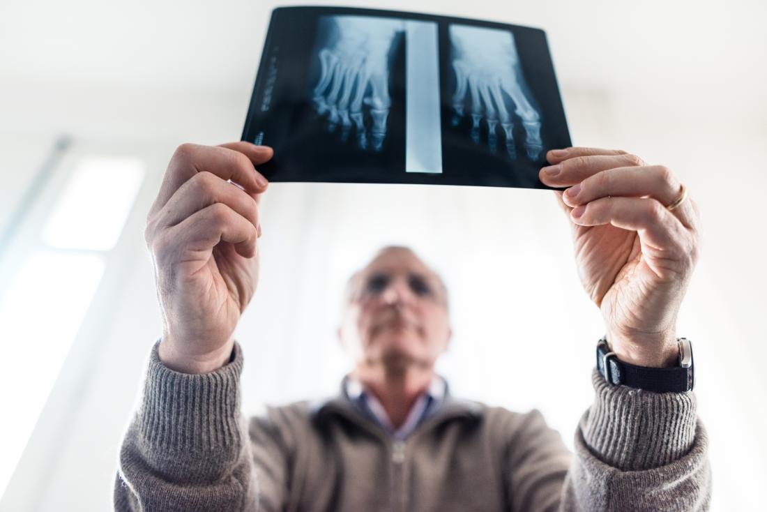Reifer Mann, der Röntgenstrahl von Fußknochen hält.