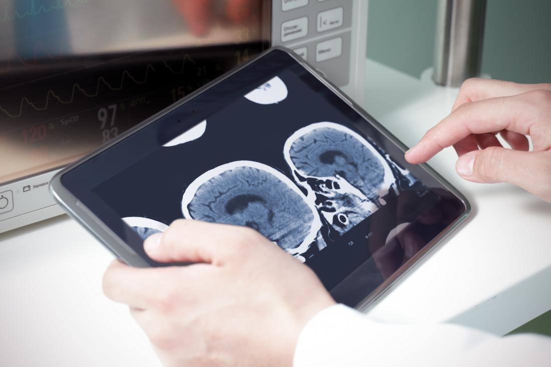 CT мозък сканира върху таблетка, която лекарят гледа.