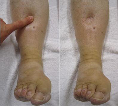 Anasarca in Bein und Fuß verursacht Schwellung.