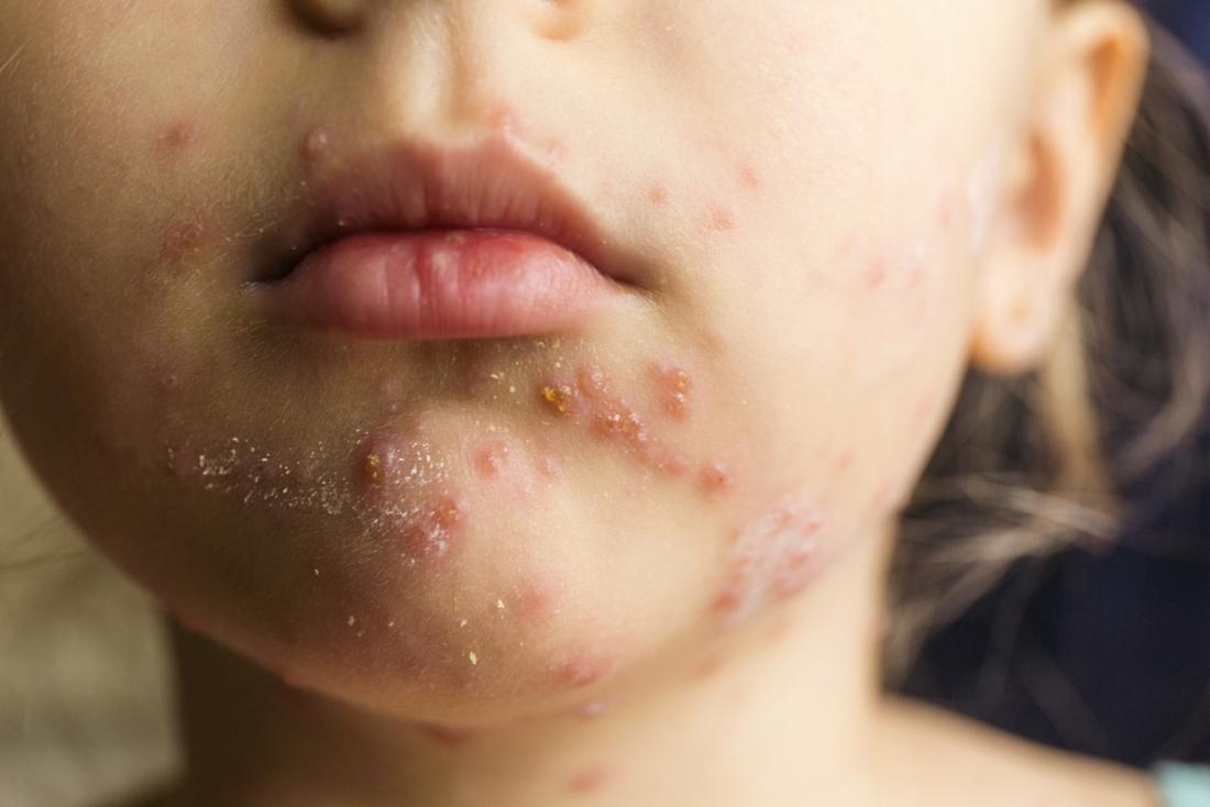 Jeune fille avec la varicelle
