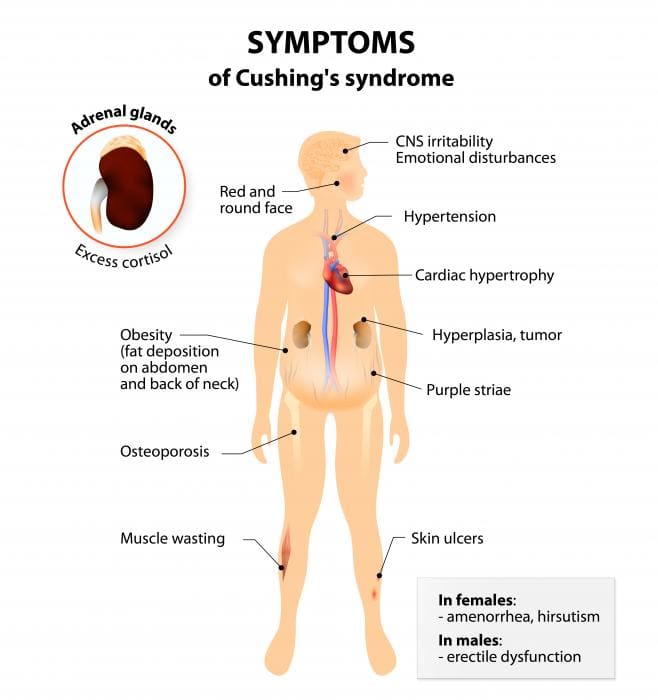 [diagramma della sindrome di Cushings]