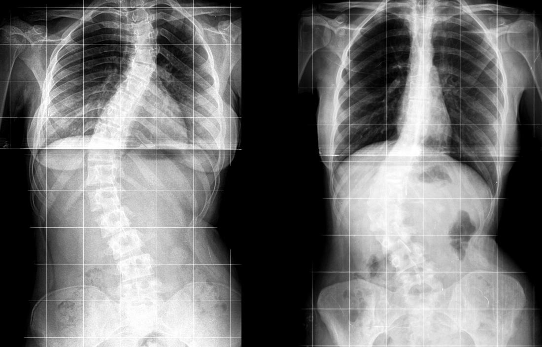 Декстросколиоза, показана в рентгенови лъчи на гръбначния стълб.