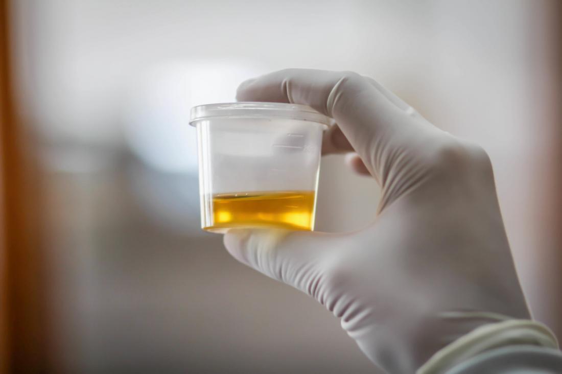urologue échantillon d'urine