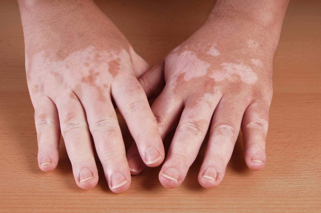 Hypopigmentation, ou vitiligo, dans les mains.