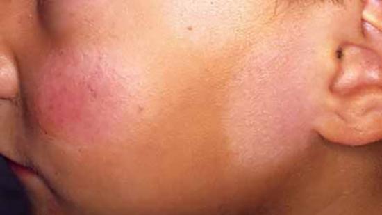 Pityriasis alba sur le visage de l'enfant. Crédit d'image: DermNet New Zealand.