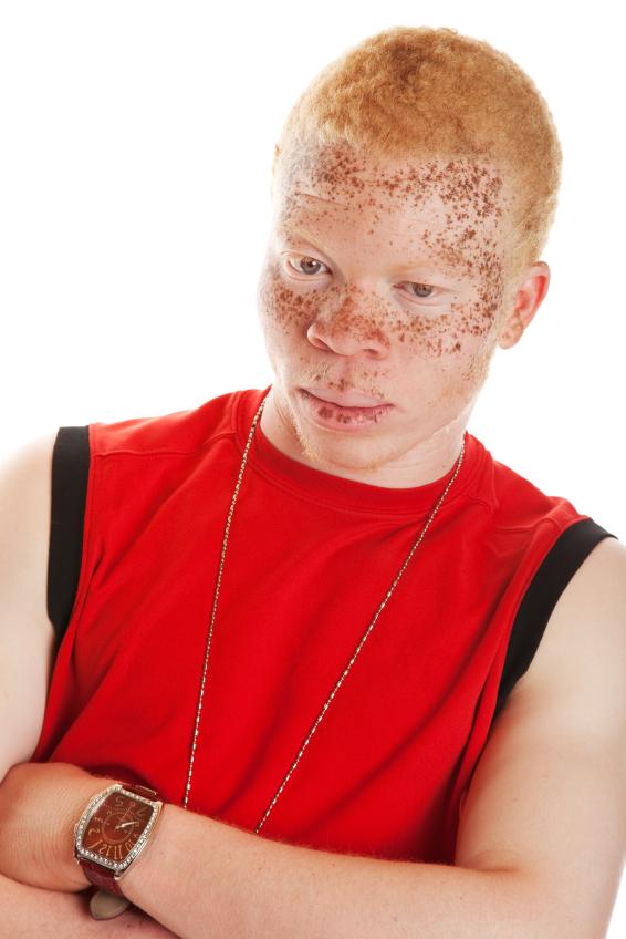 Junger Mann mit Albinismus.